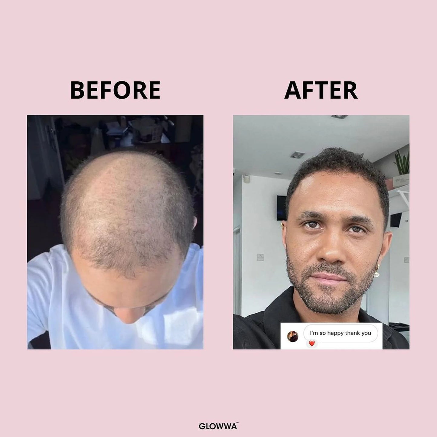 Glowwa - HAIR FOOD - Integratore Professionale per Capelli Sani e Forti